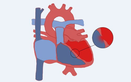 冠心病缺钾临床症状_冠心病缺钾临床症状有哪些