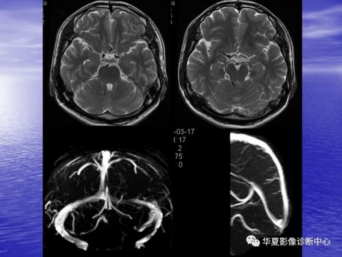 为啥冠心病总犯困 冠心病患者为什么一直犯困