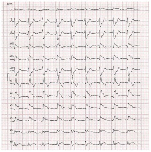 患了冠心病如何吃药 冠心病患者需要吃什么药
